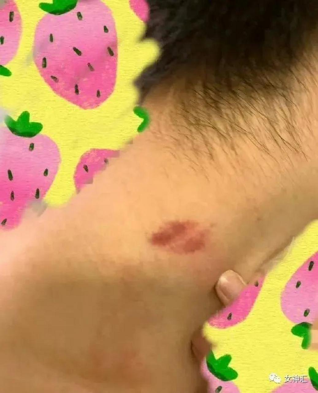 大家帮我看一下,这个是"草莓印"吗?