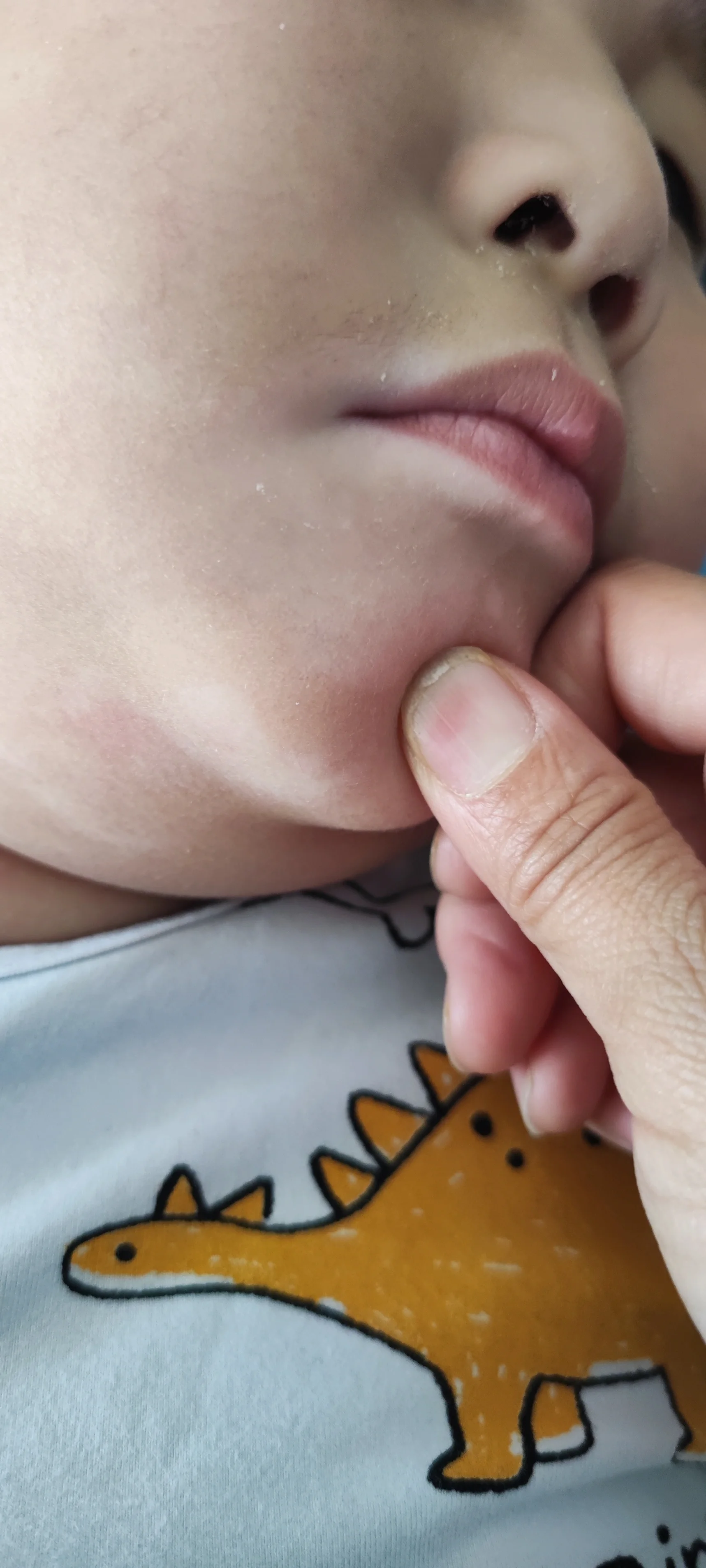 白色糠疹:又叫单纯