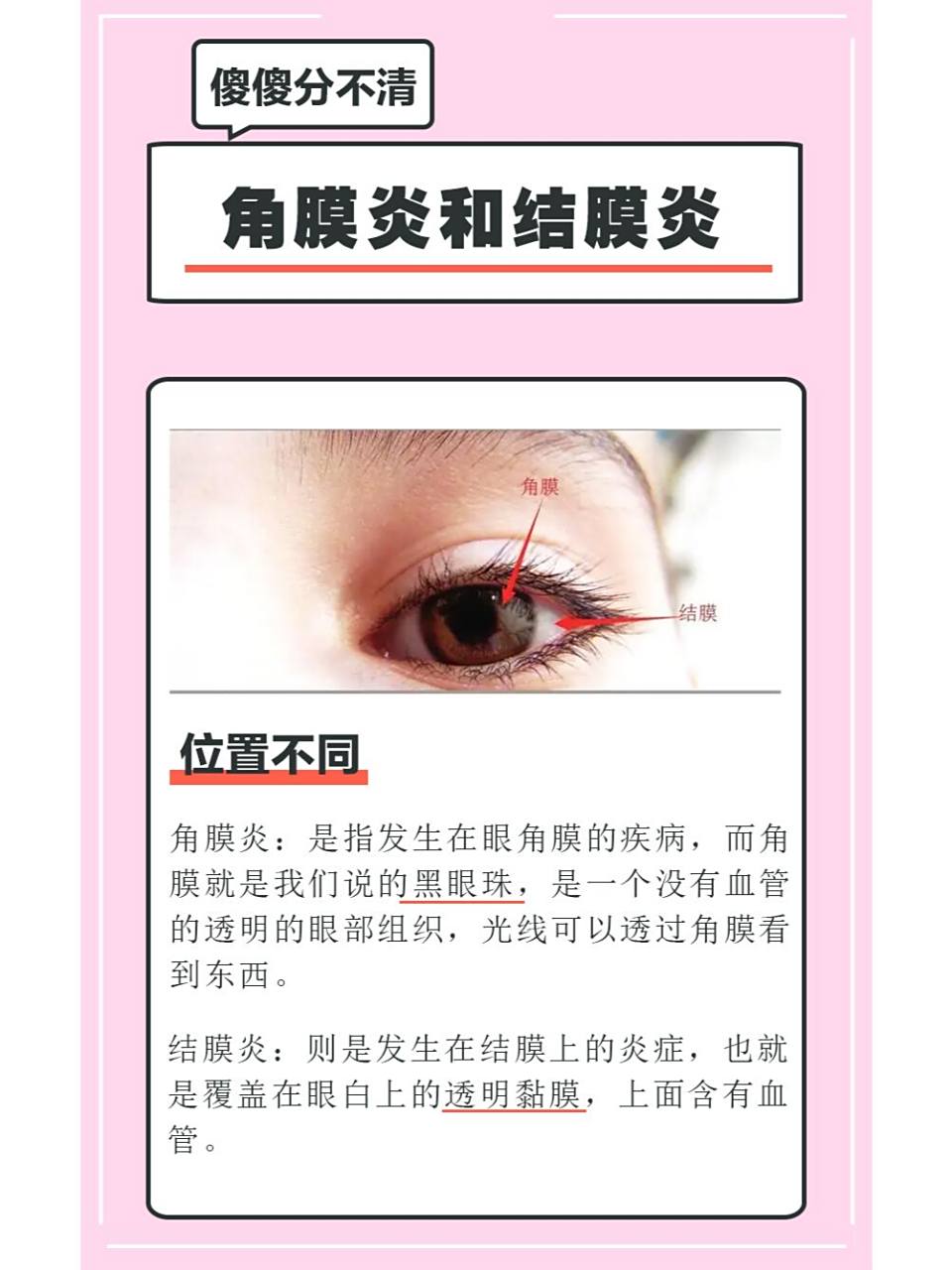 9799生活中很多人都分不清楚角膜炎和结膜炎的区别,其实,角膜炎