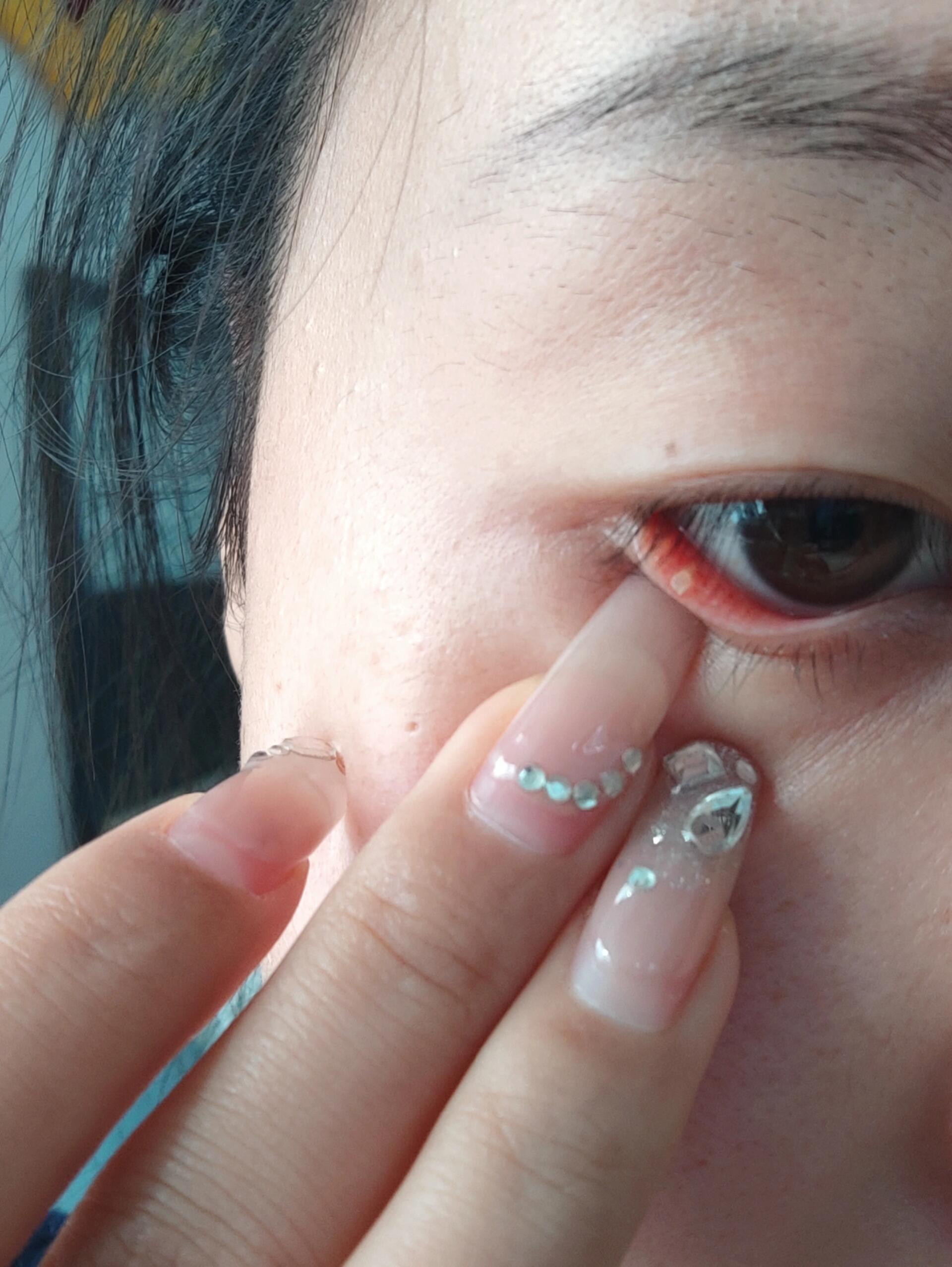 不要慌,遇事先拍照 上班无聊,自己动手把眼睑结石取出来了,三个还怪硬