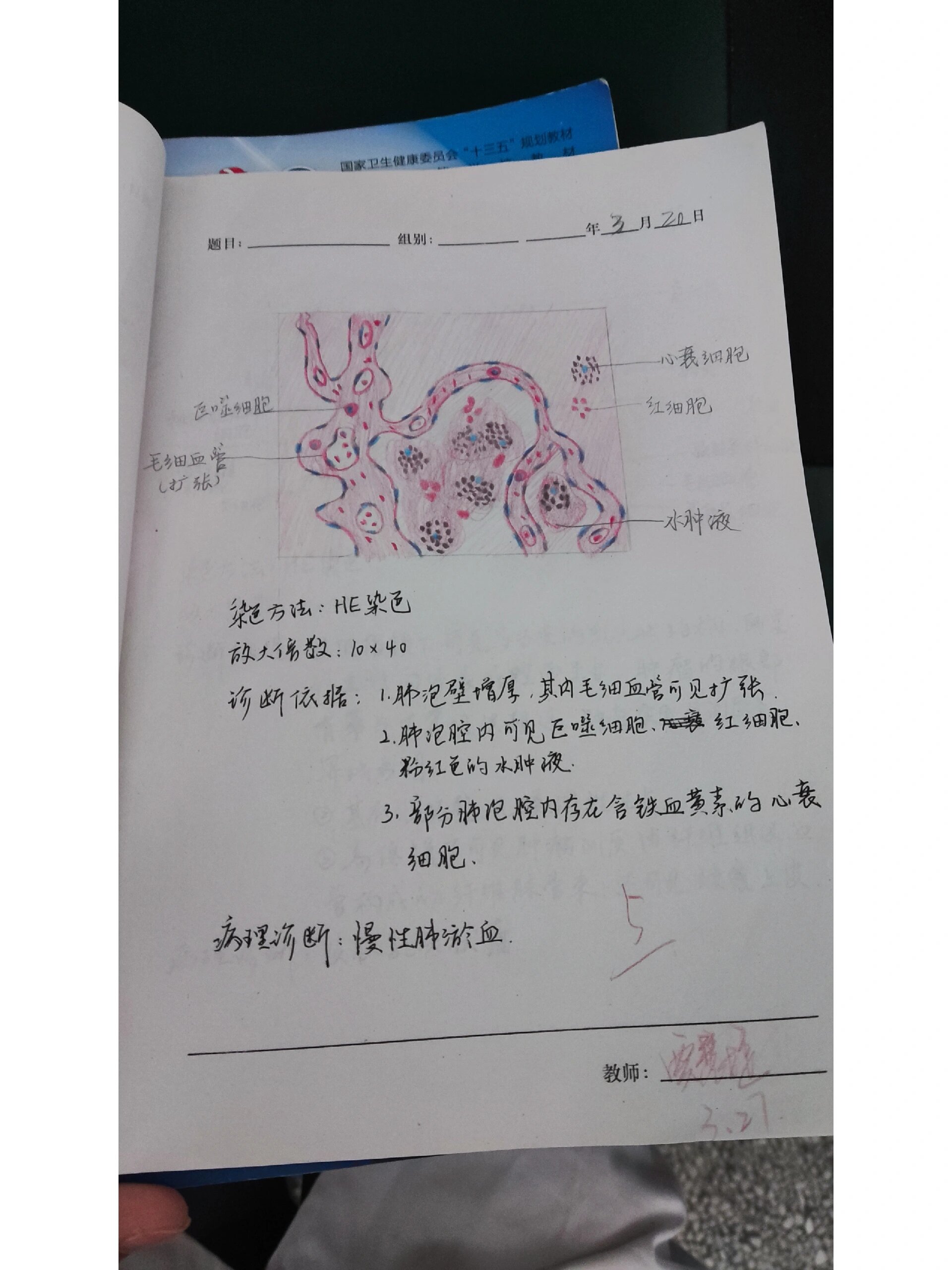 慢性肺淤血病理实验    病理学慢性肺淤血红蓝铅笔绘图