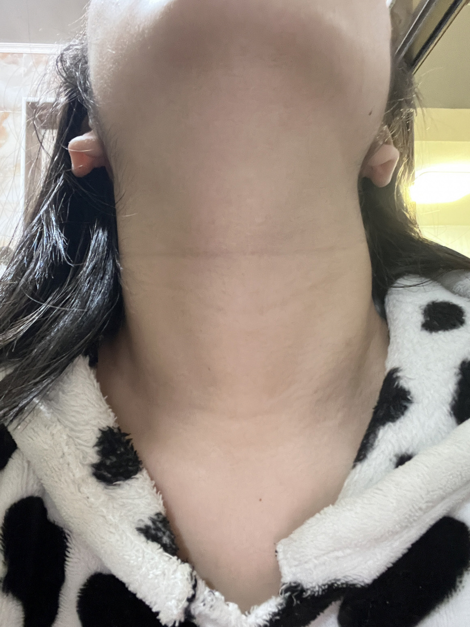 女性甲减早期脖子图片图片