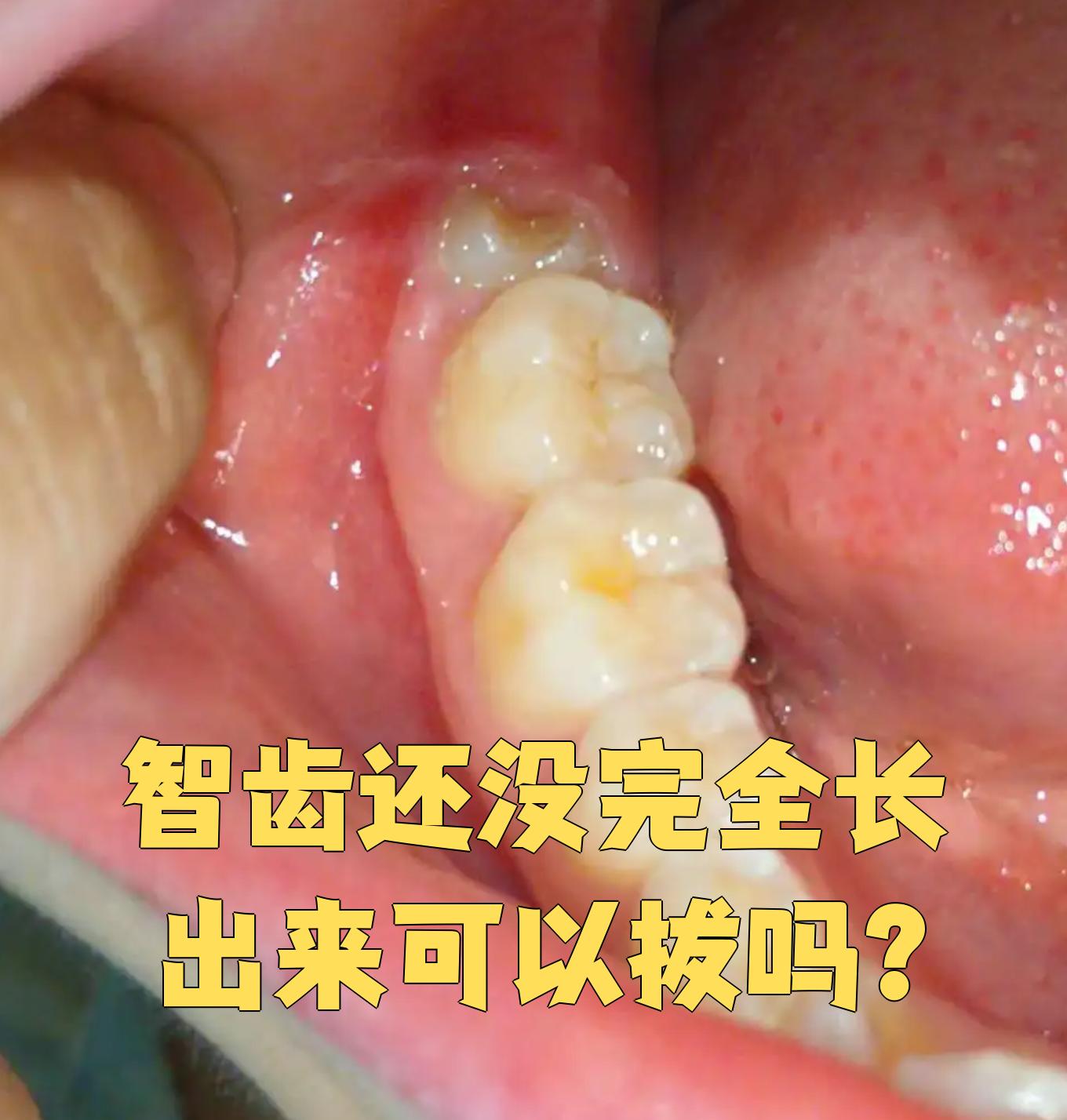 智齿没完全长出来是可以拔的,但需要先到正规医院口腔科检查