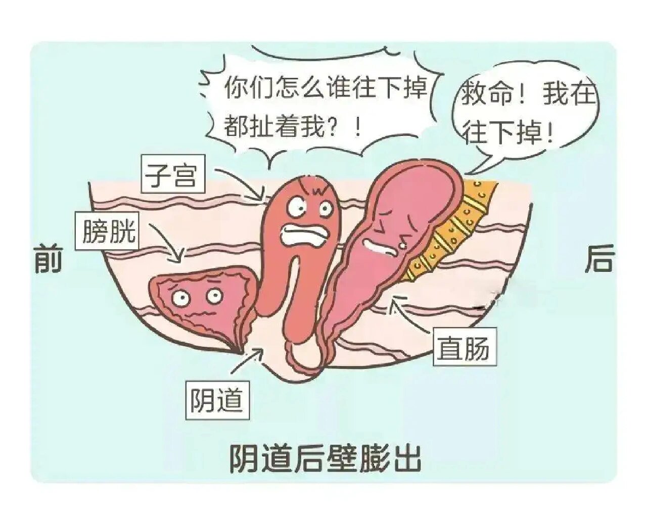 膀胱脱垂图片真实图片图片