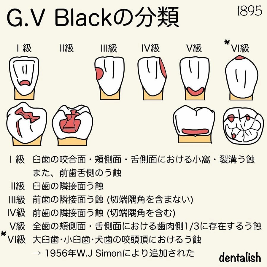龋洞分类英文