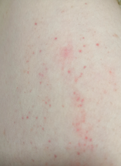 睡醒后发现手臂上有很多小红点,常见原因包括过敏,虫咬皮炎或湿疹