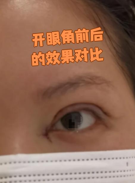 开眼角前后的效果对比