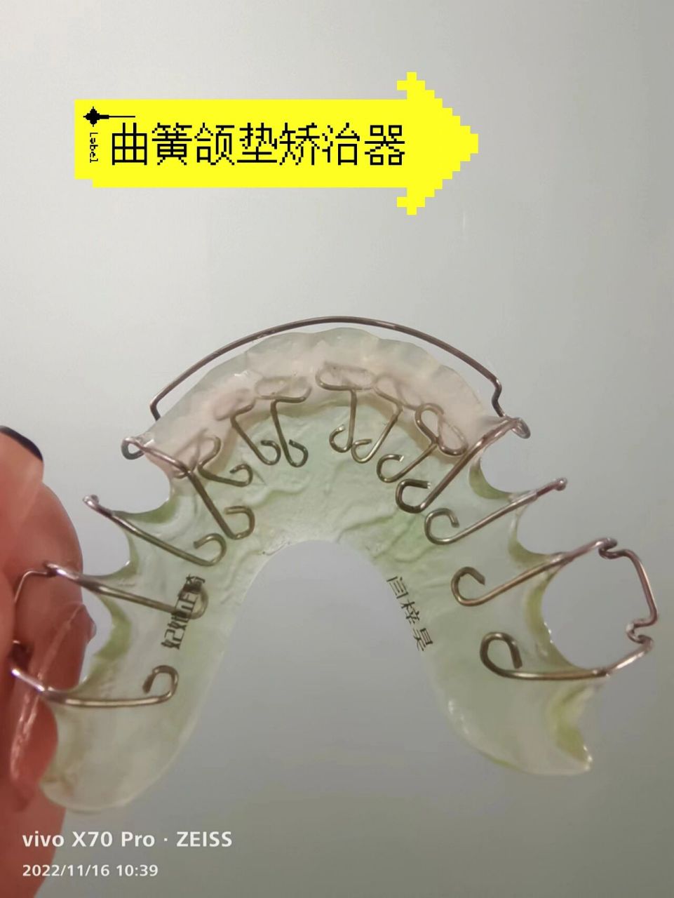 反颌神器-曲簧颌垫矫治器 快收藏9797
