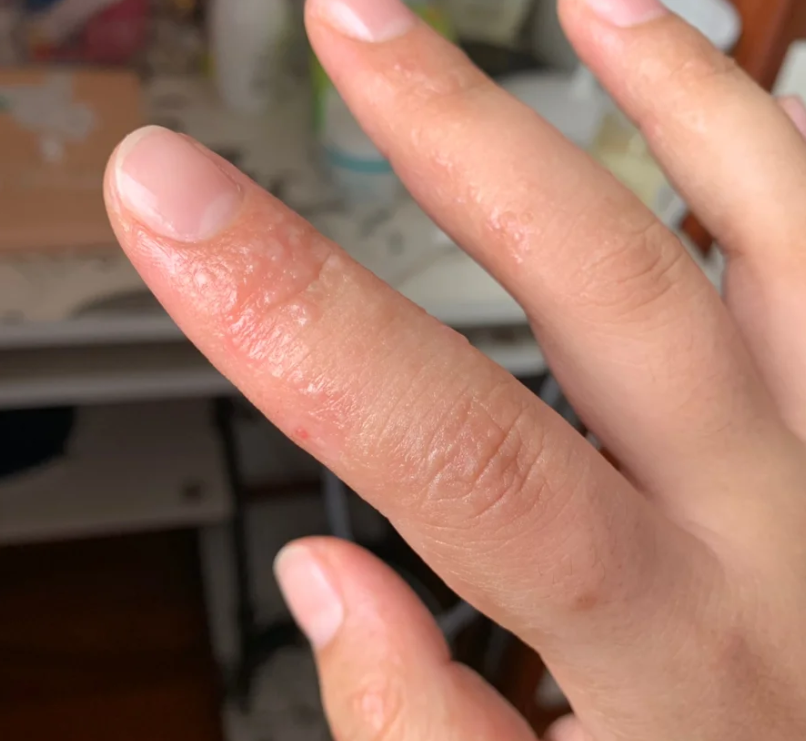 手上长了类似水泡的小疙瘩很痒是怎么回事怎么办?