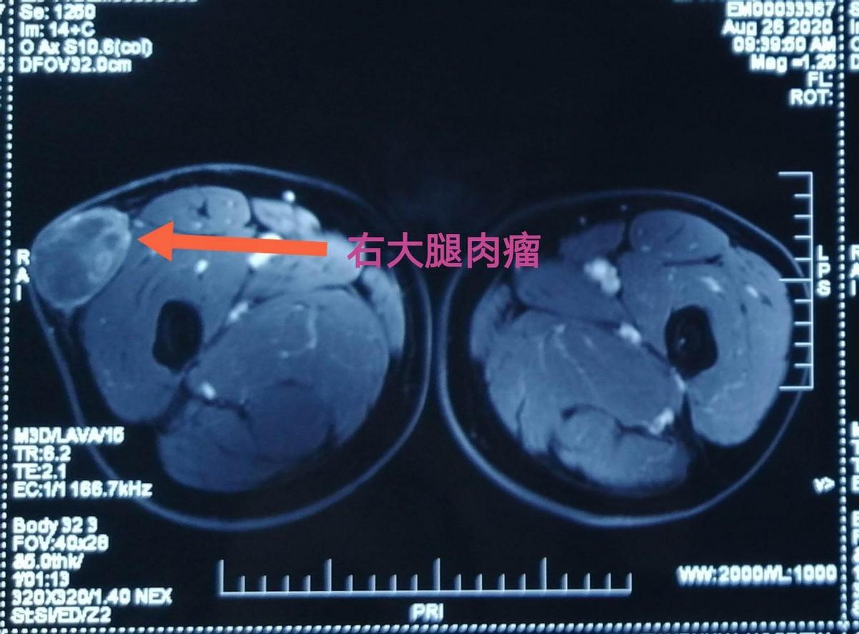 大腿肌肉囊肿图片图片