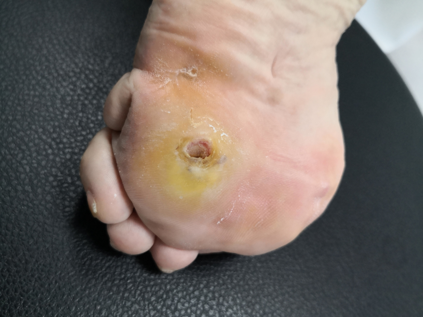 足底鸡眼,周围胼胝.坚持药物治疗观察.