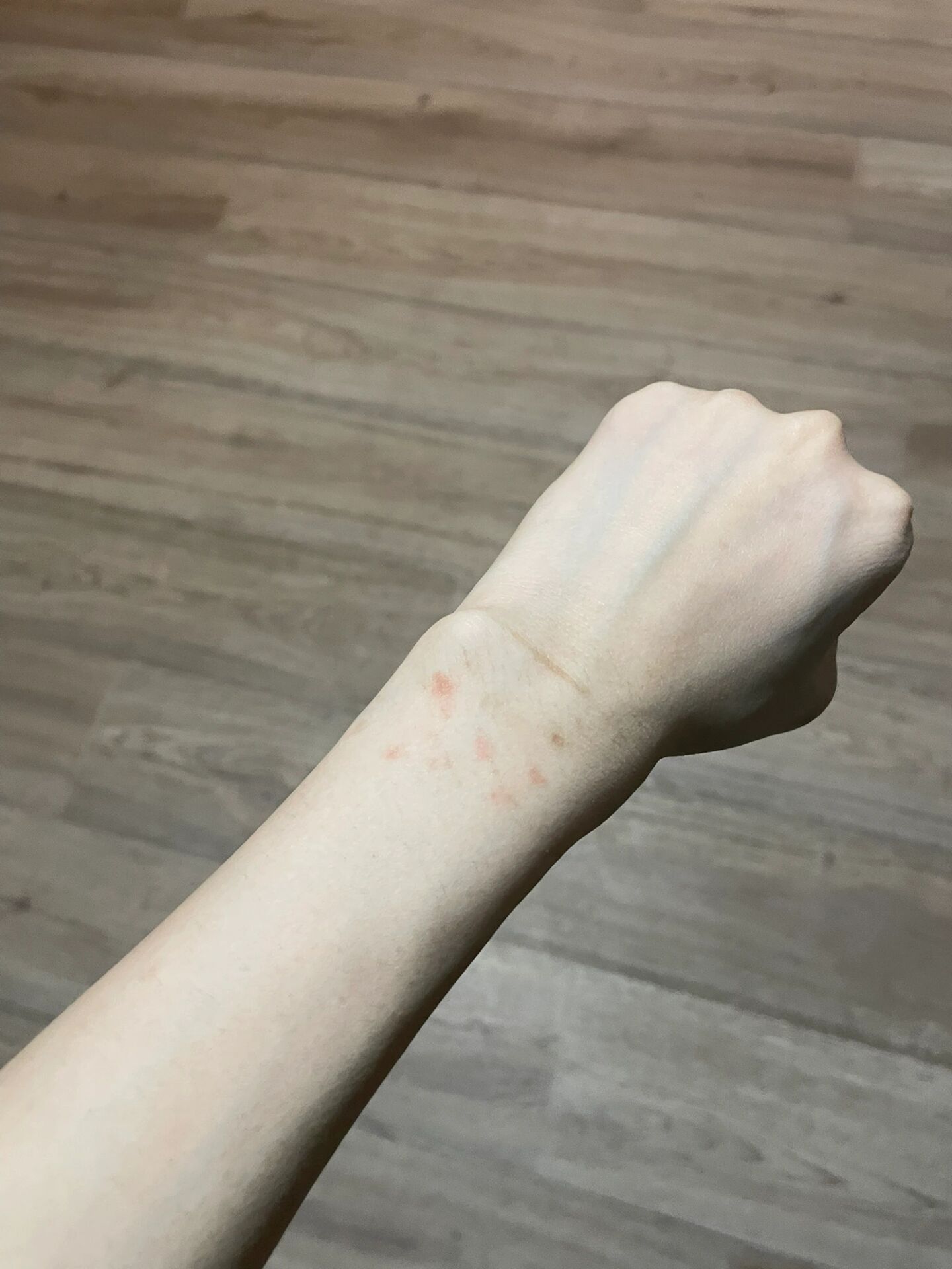 海娜纹身过敏 上个月画了海娜纹身,现在颜色掉完了才发现胳膊上过敏起