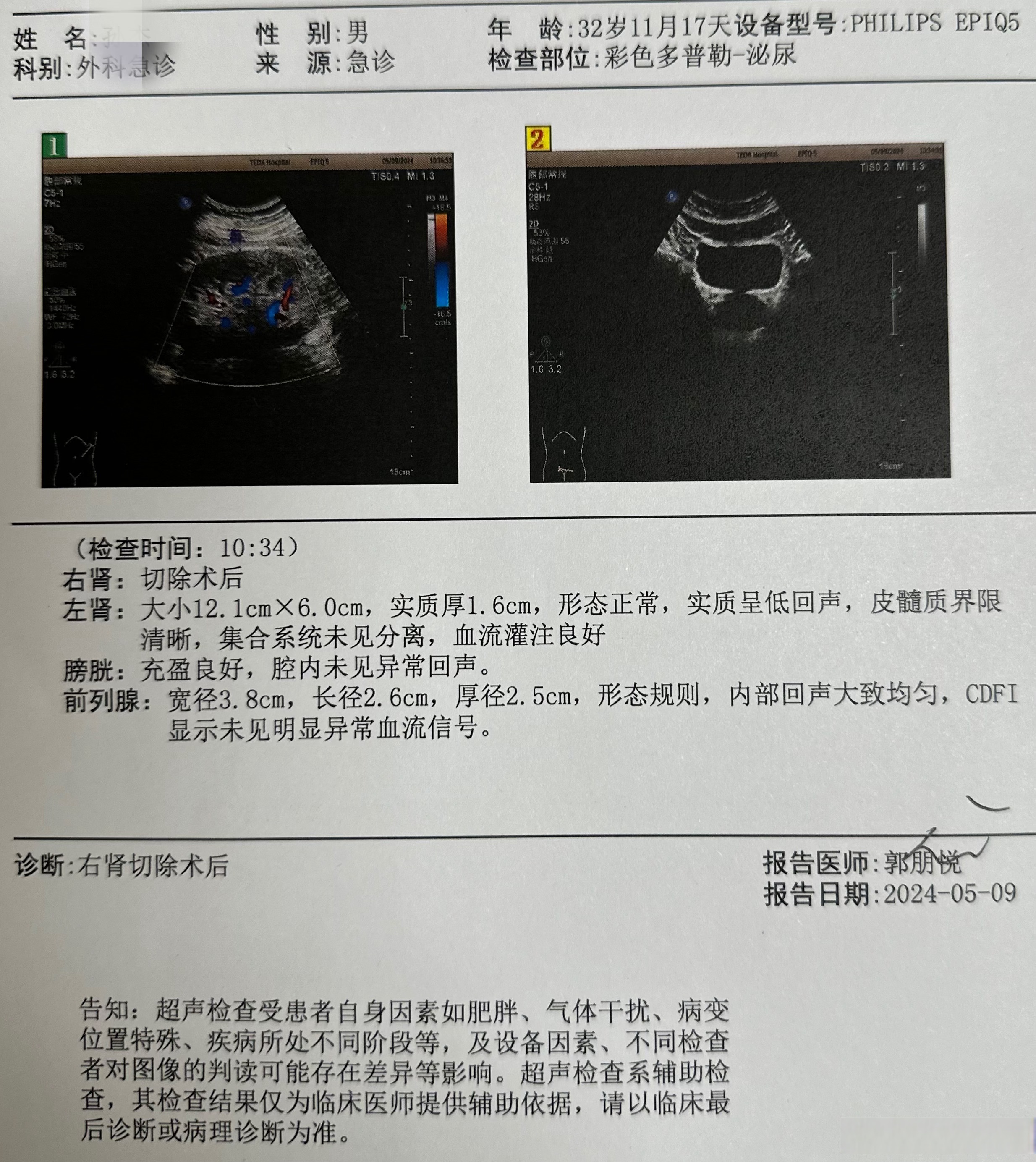 肾结石ct图片 报告图片