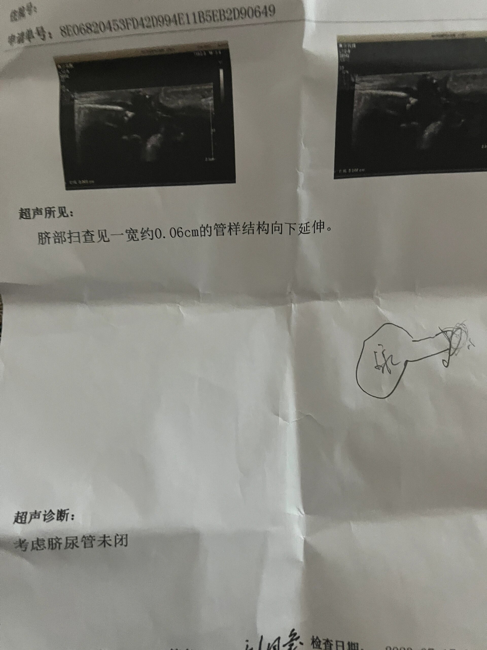 新生儿脐尿管未闭 肚脐一直渗水,做了b超说是脐尿管未闭,有一样情况的