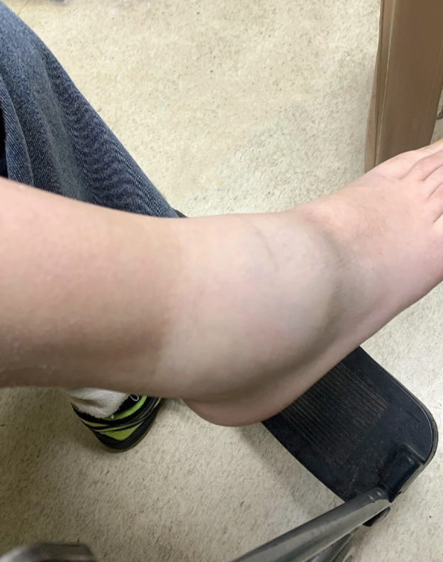 脚扭伤为什么会肿 脚扭伤为什么会肿