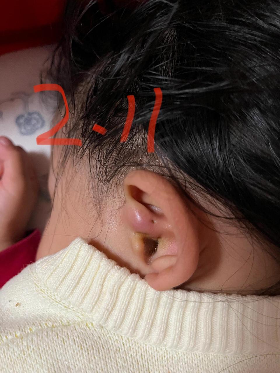 耳瘘管突然发炎了,怎么处理 先天耳瘘管 突然发炎了,之前轻微发炎过没
