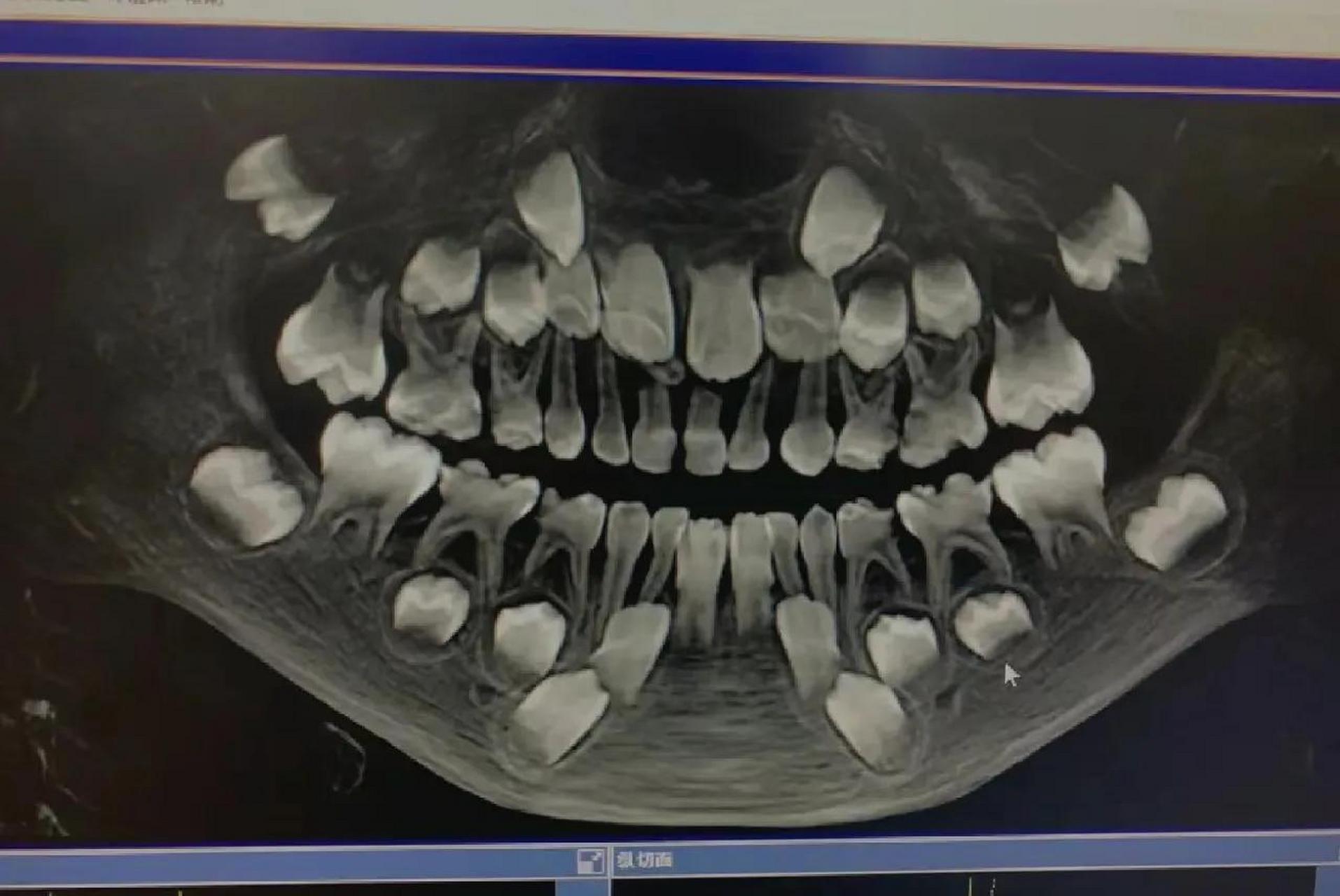 第一次见小朋友的牙片……真是满嘴牙