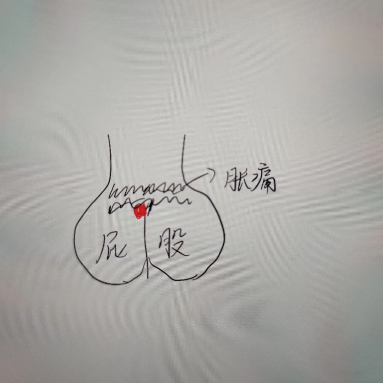尾巴骨边上长了疖肿怎么办呀 已经第五天了,紧贴着尾巴骨,在左侧长了