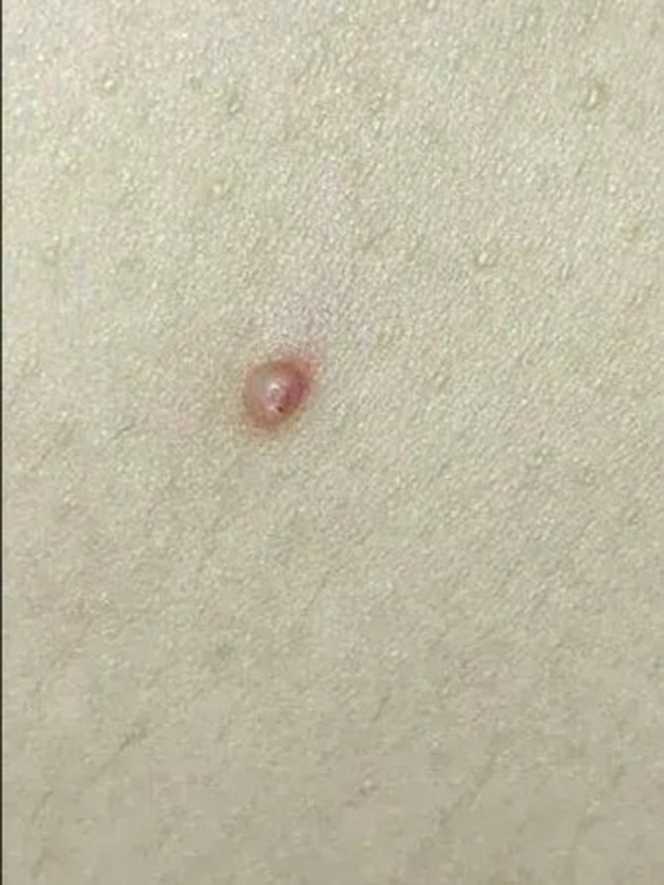 传染性软疣俗称"水瘊子",是由痘病毒中的传染性软疣病毒感染人体皮肤
