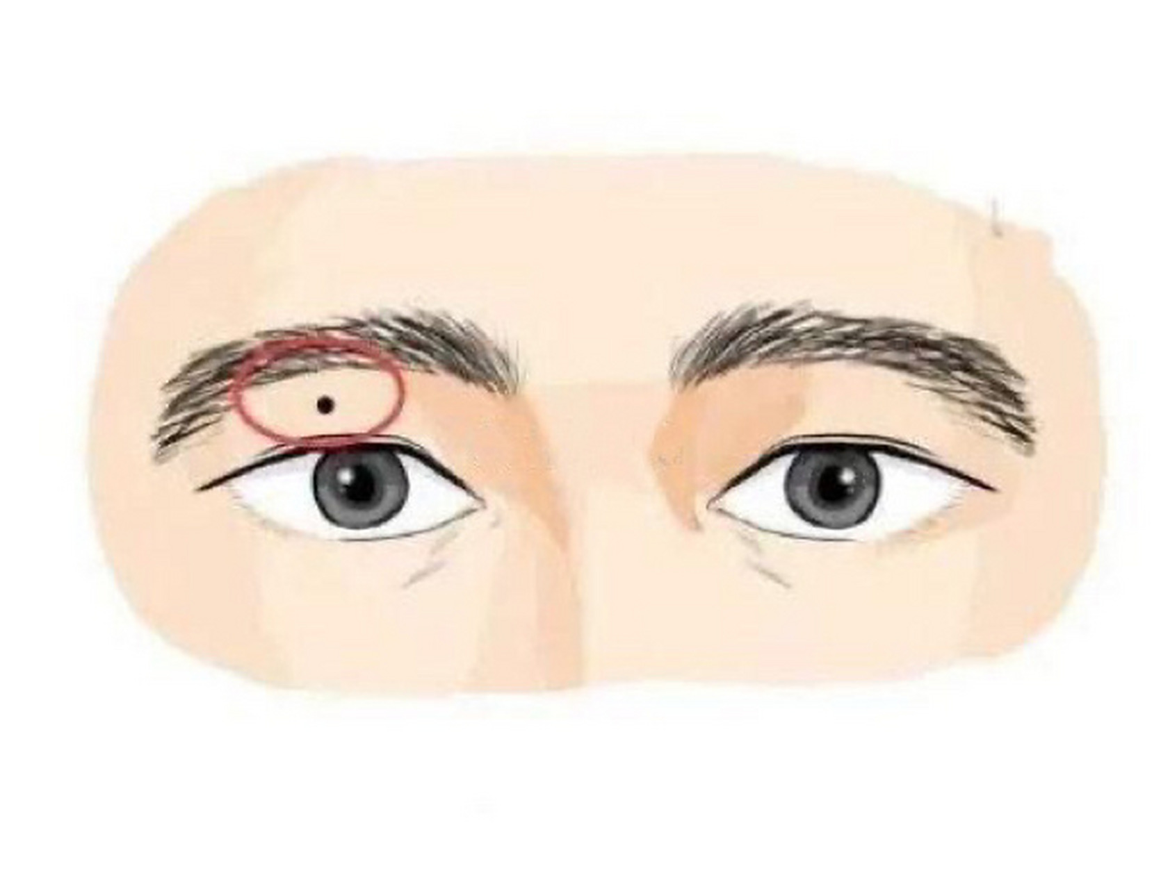 上眼皮有痣是好是坏?