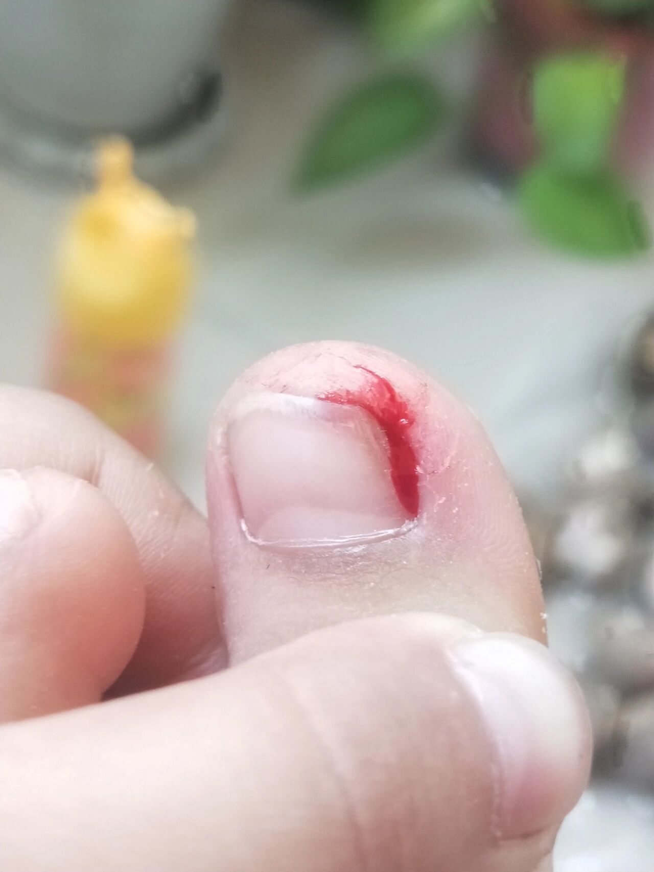 脚流血了,好痛!😭