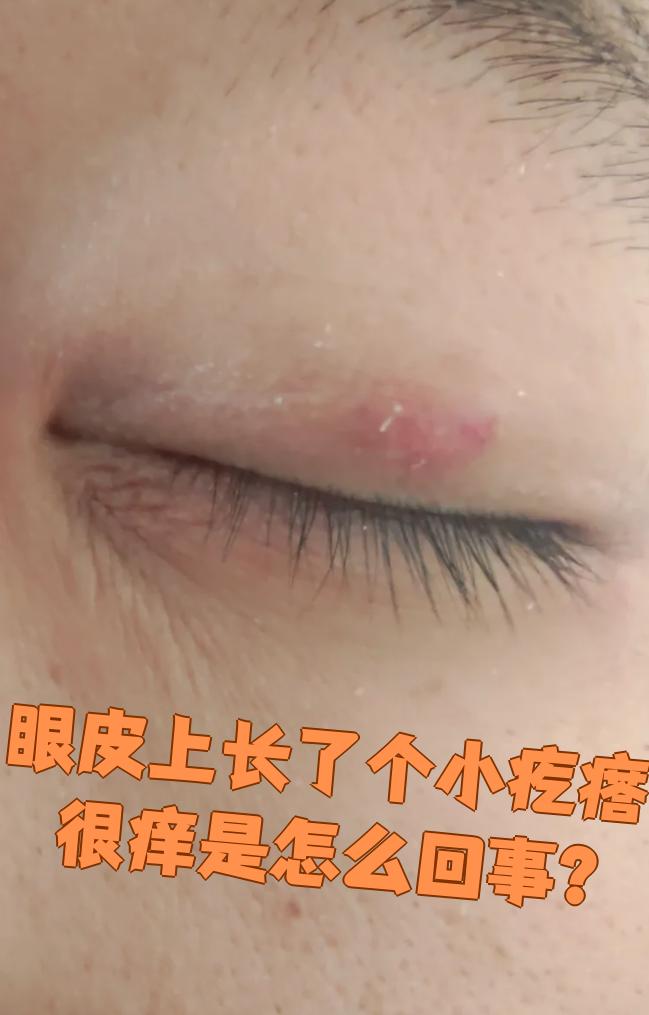为什么上眼皮肿 为什么上眼皮肿