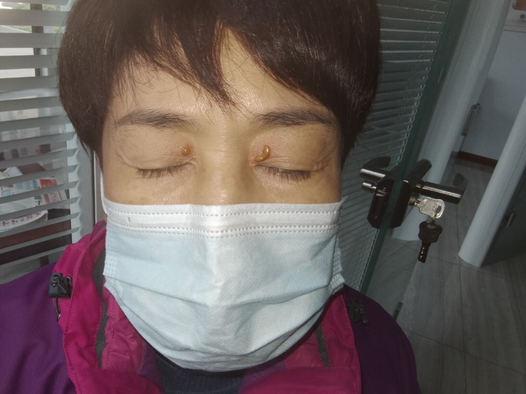 轻轻一点,去除睑黄疣