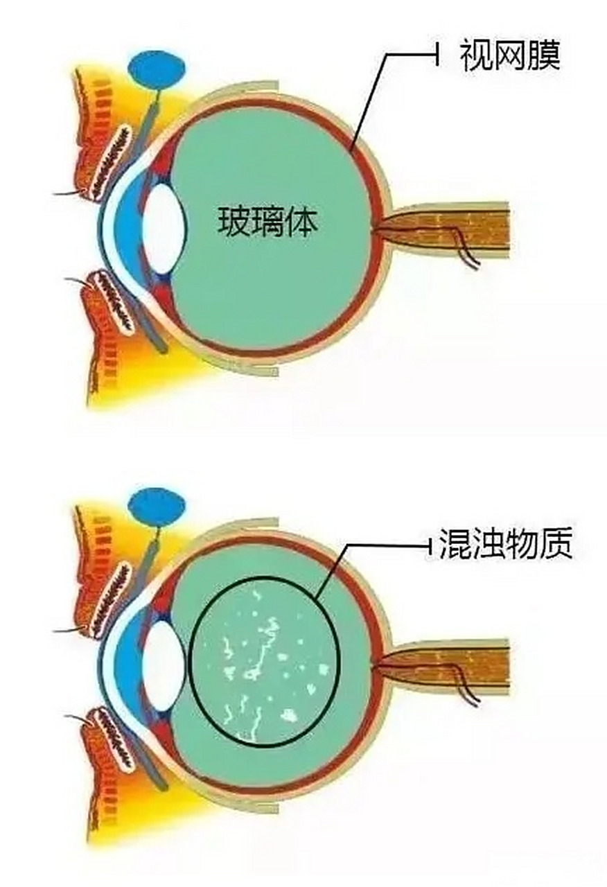 什么是玻璃体混浊?