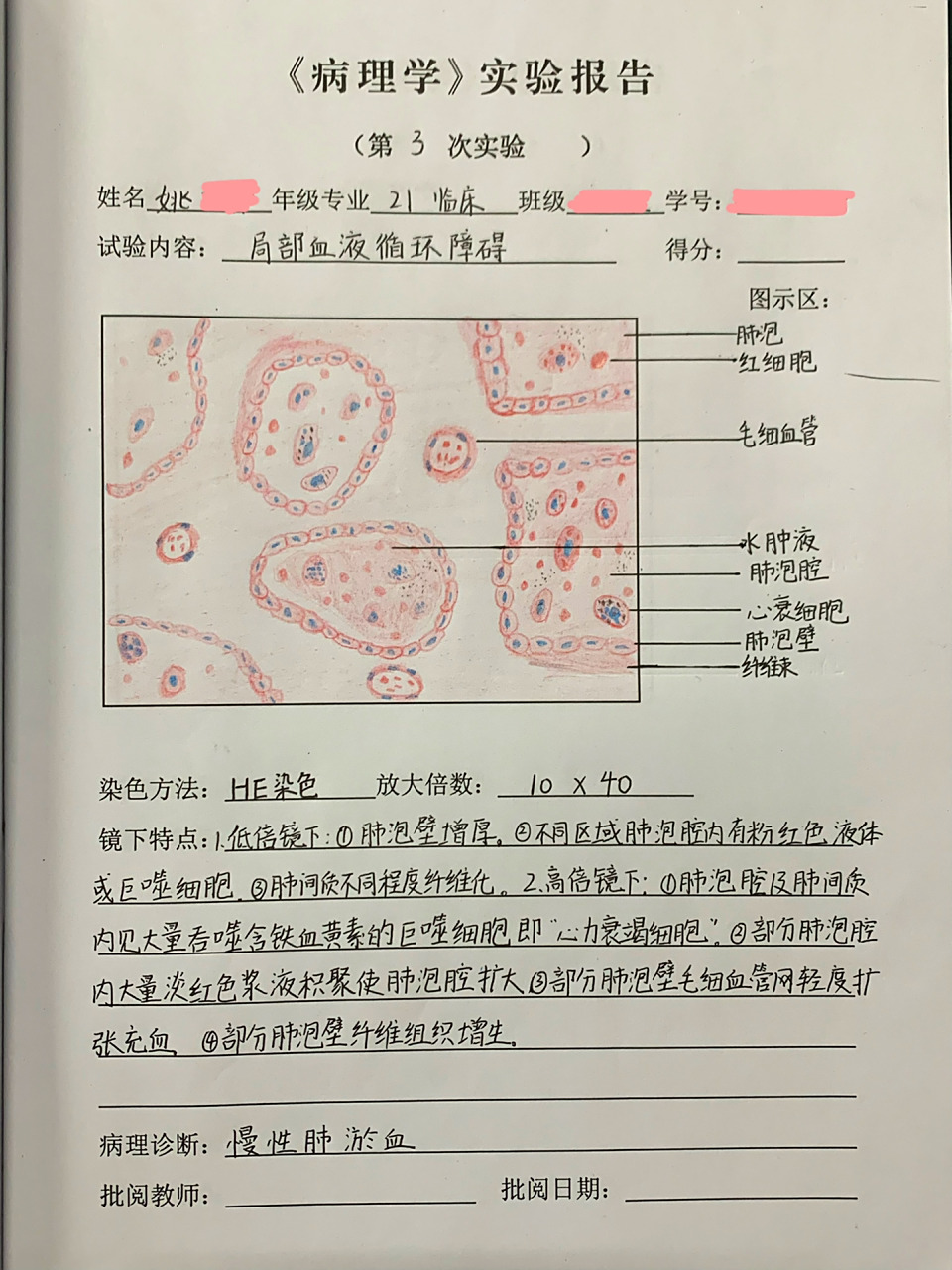 病理学实验报告三 慢性肺淤血
