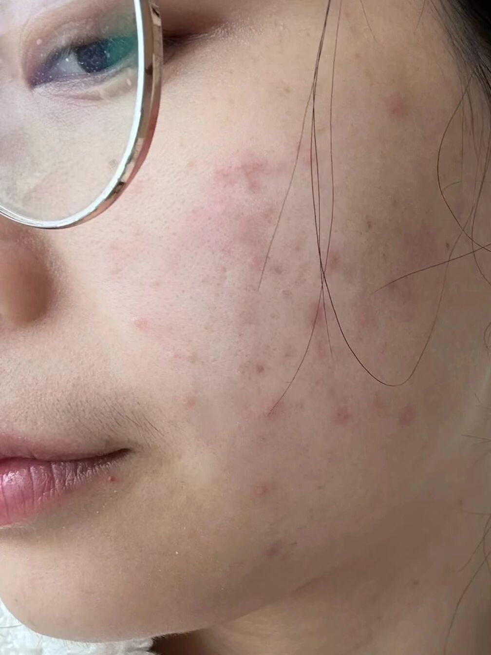 红脸部过敏发红发痒怎么快速消除脸上过敏长痘痘图片脸上痘痘过敏图片