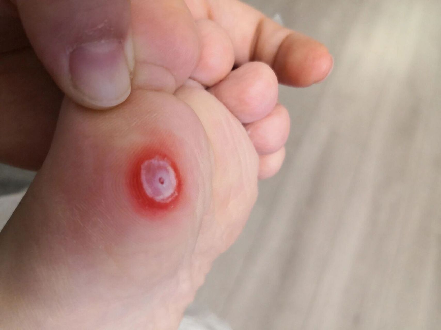 七岁娃脚上鸡眼治疗一周痊愈 luna突然早上说脚疼,昨天还欢蹦乱跳