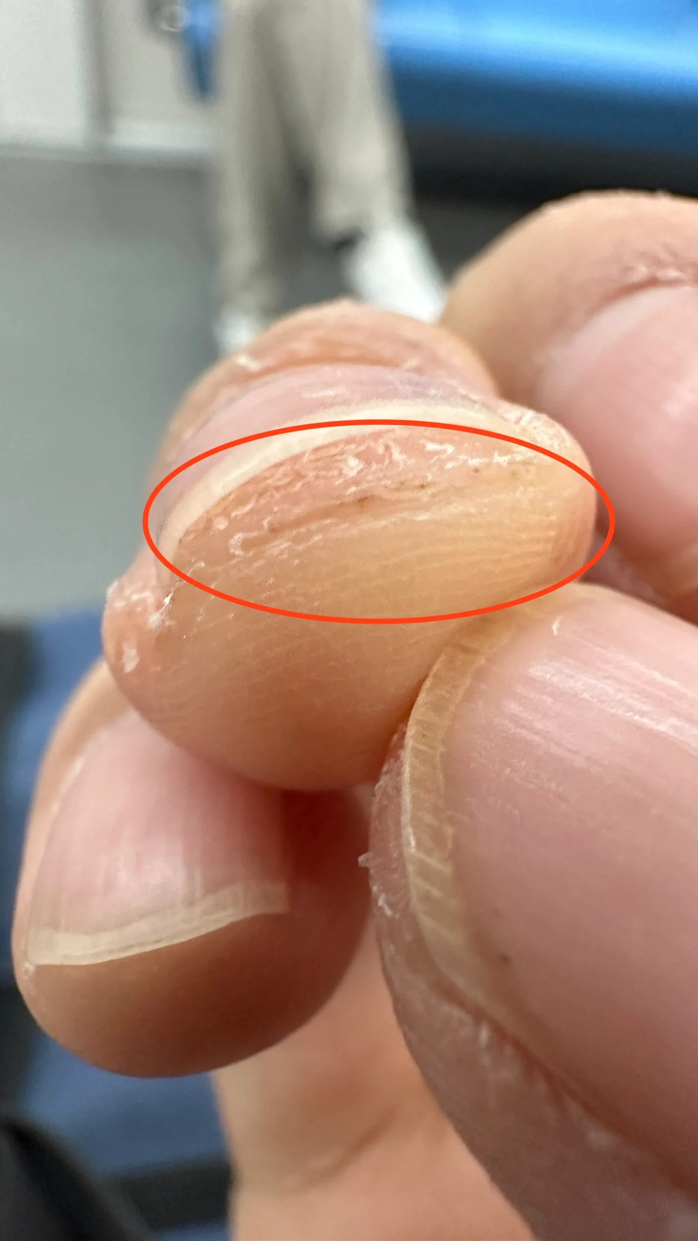 万能的书友们,帮忙看看,这不会是黑色素瘤吧 工作将常用到这根手指
