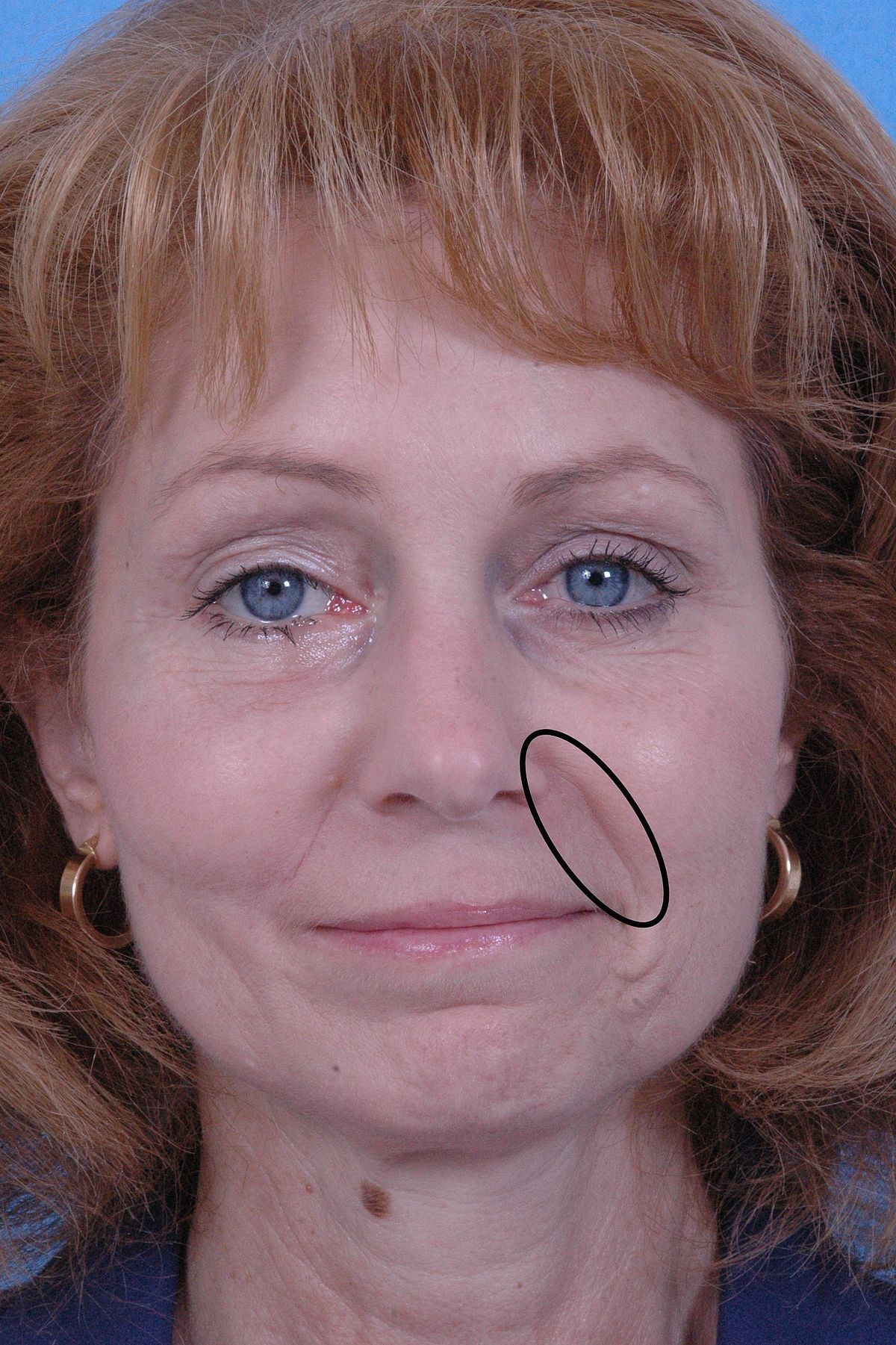 1,太阳穴凹陷:会导致面部的上半个轮廓变得突出,比如颧骨,让人看