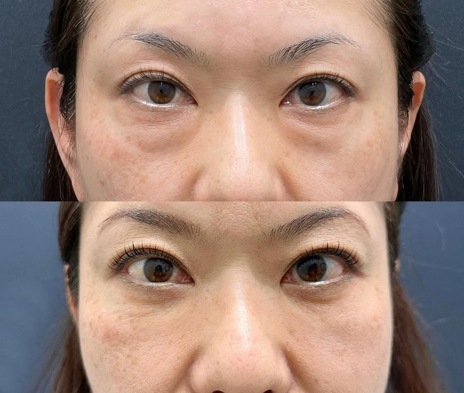 46岁,做完外切祛眼袋半年  因为眼袋明显和松弛,做外切适合她,做完后