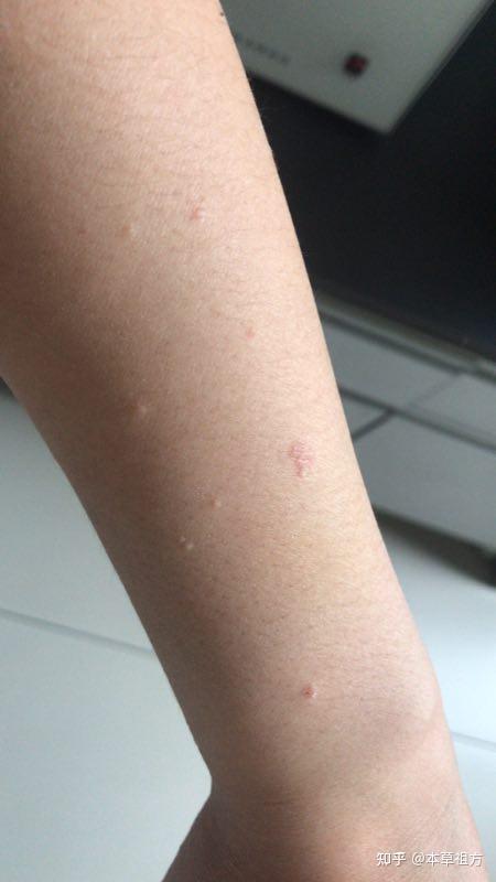 求治疗小扁平疣的方法