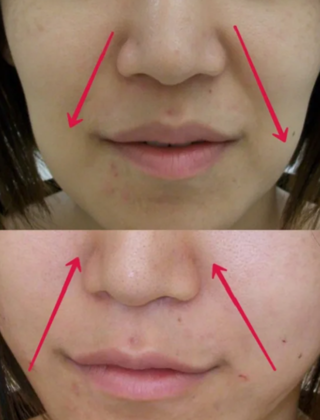 她勇敢地尝试了玻尿酸填充法令纹,现在好想听听大家的真实感受和建议.