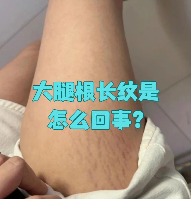 膨胀纹也叫萎缩纹.刚开始可能是淡红色的条纹,慢慢会变成淡白色