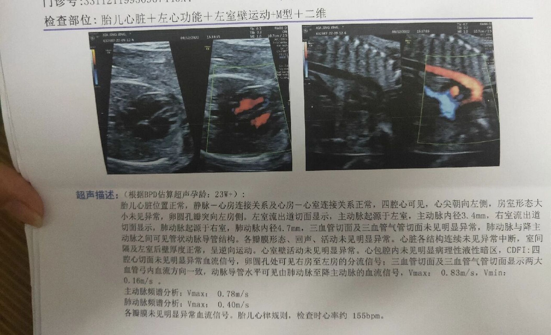 三维 胎儿心脏彩超,顺利通过啦05 心心念念做三维的日子, 期待见到