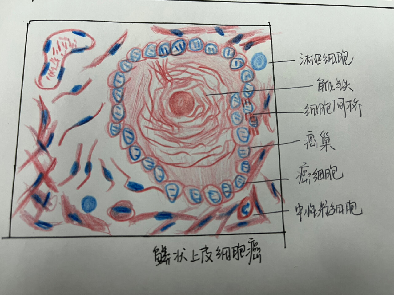 直肠腺癌红蓝铅笔绘图图片