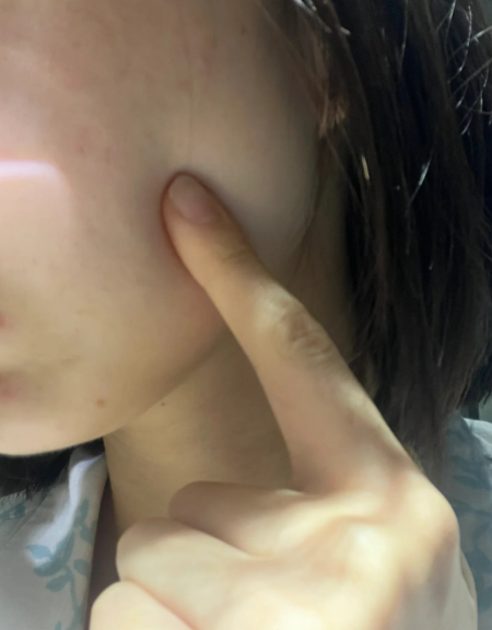 左腮帮子摸到肉疙瘩可能是表皮囊肿或脂肪瘤