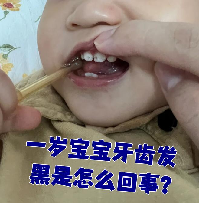 一岁宝宝牙齿发黑最常见的原因是牙齿龋坏,牙髓坏死或外源性色素沉