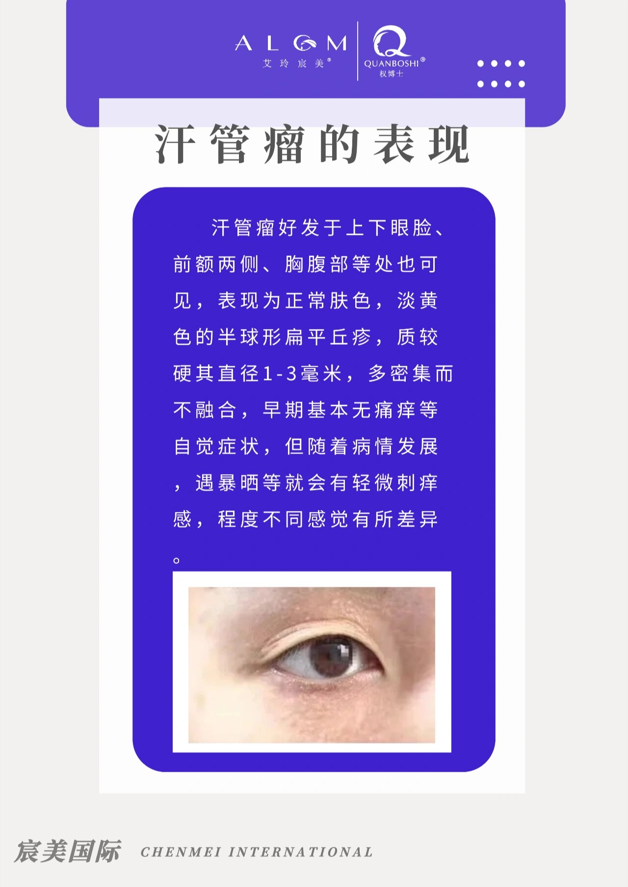 汗管瘤严重吗图片