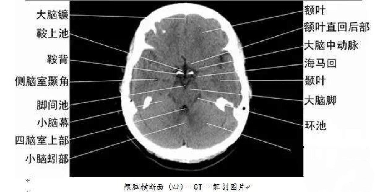 颅内血管CT解剖图图片