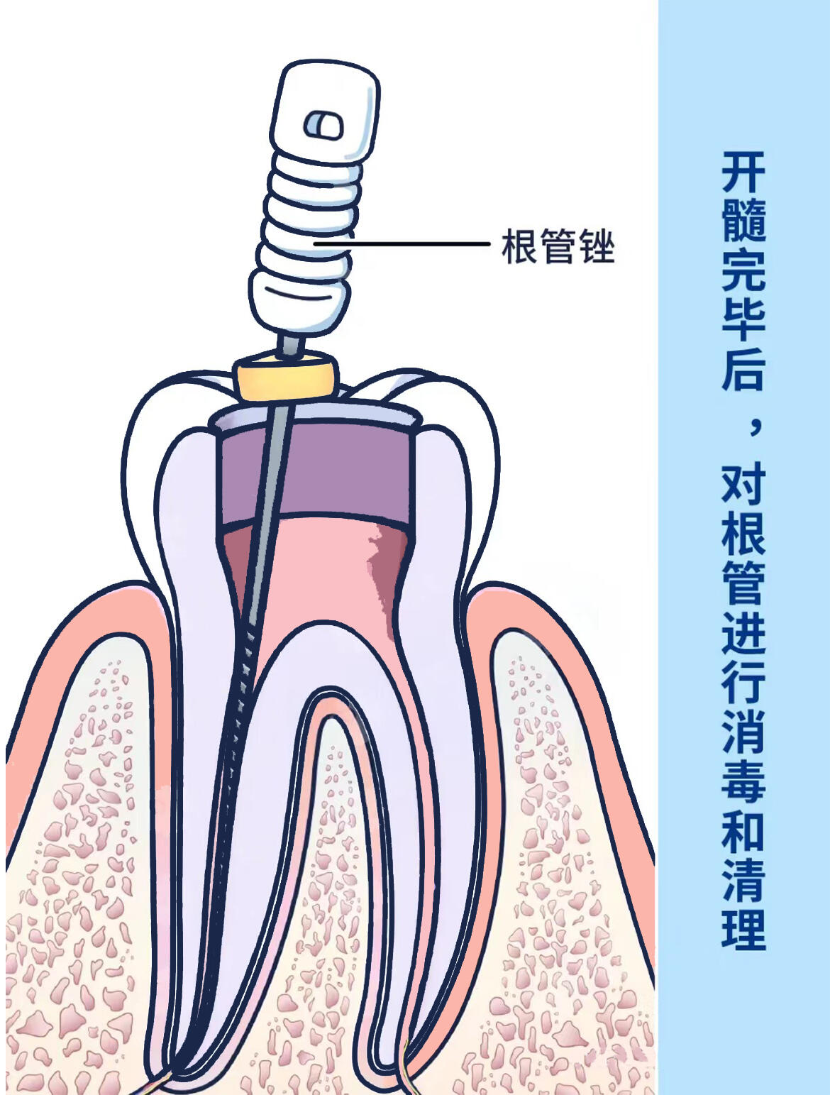 根管治療步骤图 根管治疗详细步骤