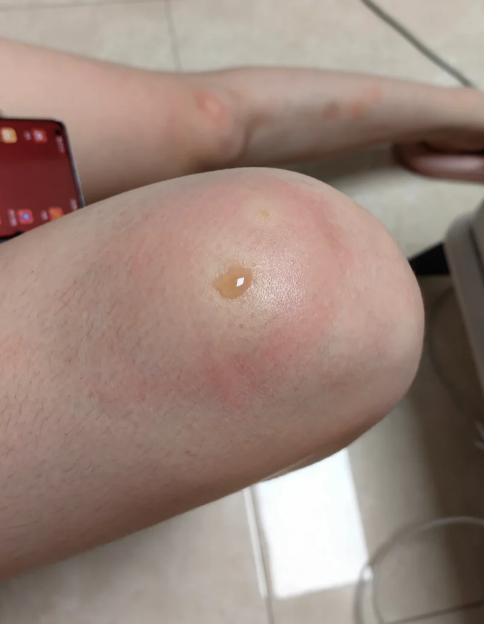 如果是组织液渗出,这很正常