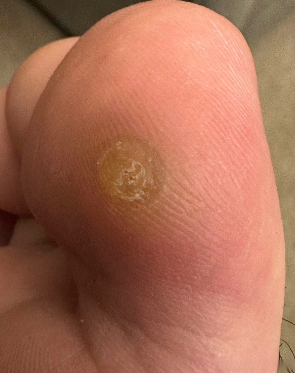 健康美好生活计划# 脚大拇指指腹长了一个疙瘩,约有半年时间,结痂