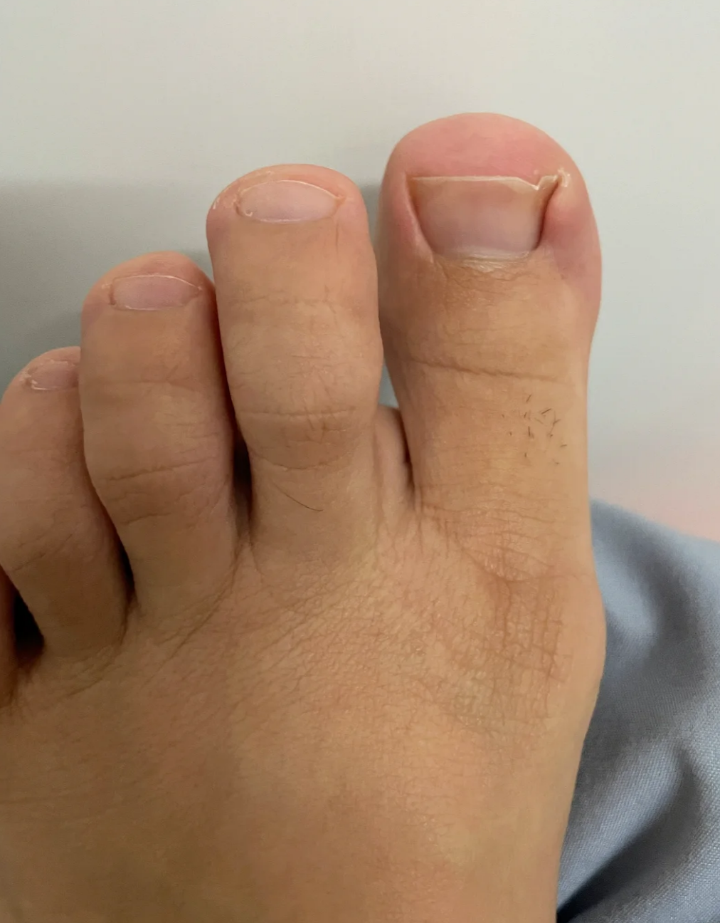 睡醒后脚的大拇指突然很疼,常见原因有滑囊炎,劳损受凉或跖趾关节炎