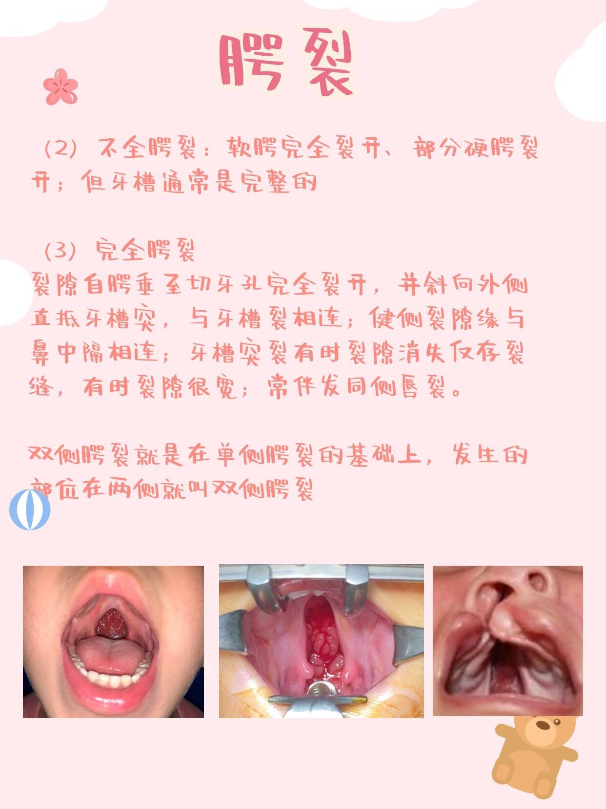 唇腭裂图片对比图片