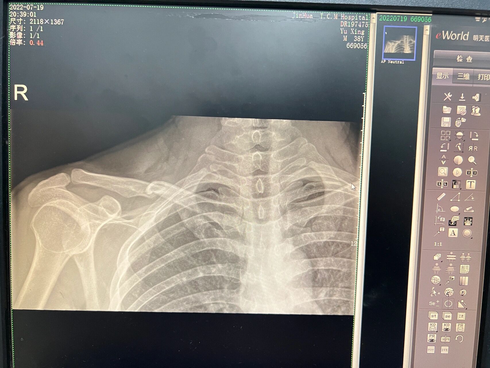 锁骨骨折多久可以骑车?分享一下我的经历!