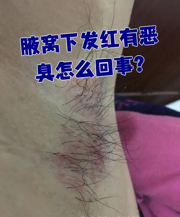 腋窝下发红还带臭味,这情况可能是红癣,腋毛癣或者臭汗症引起的